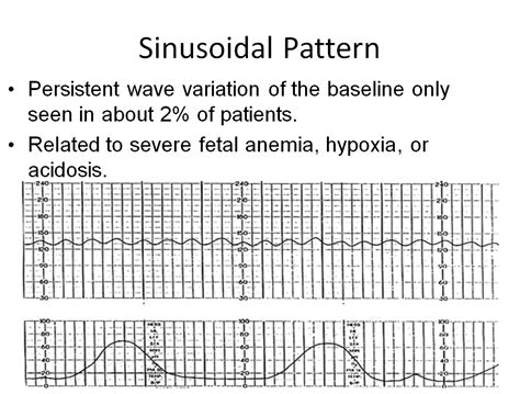 Pseudo-sinusoidal FHR patterns include all patterns in which undulatory waveforms, or regular FHR baseline oscillations of constant amplitude, . . Pseudo sinusoidal pattern vs sinusoidal